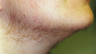 Excess Hair May Be A Sign Of Health Problems In Women